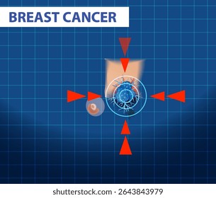 Vector illustration showing breast cancer cells with anatomical accuracy, highlighting tumor location and structure in vibrant colors