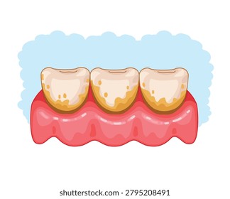 Vector illustration showing dental plaque accumulation along the gumline and tooth surfaces.