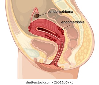 Ilustração vetorial mostrando endometriose e endometrioma no sistema reprodutor feminino. Rotulagem clara e precisão anatômica