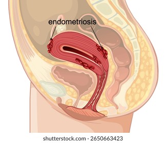 Ilustração vetorial mostrando endometriose no sistema reprodutor feminino. Representação anatômica detalhada com rotulagem clara e cores vibrantes