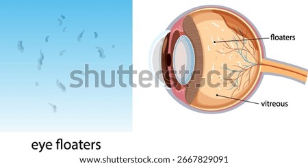 Vector illustration showing eye floaters in vision and a labeled cross-section of the human eye highlighting floaters and vitreous body structure