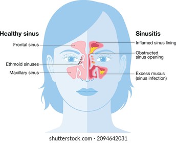 Sinus surgery lawyer