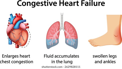 Vector illustration showing heart, lungs, and swollen foot. Highlights symptoms of congestive heart failure with clear, educational visuals
