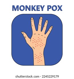 Vector illustration showing a human hand with red rash spots labeled “Monkey Pox.” Medical concept depicting infectious disease symptoms and dermatological infection signs.