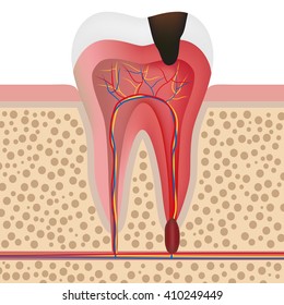 Vector Illustration Showing Infected Tooth With Pulpitis.