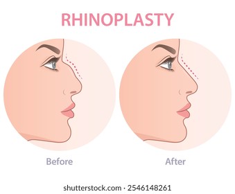 Vector illustration showing rhinoplasty. Female mose plastic surgery infographic.