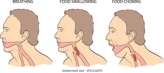 Vector Illustration Showing Where Food Goes When You Are Choking.