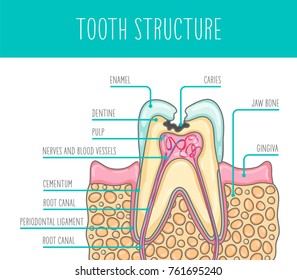 Vector illustration of a sick human tooth human tooth structure. The illustration is suitable for dental posters, leaflets and so on.