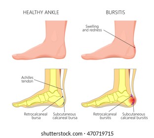 Vector Illustration of Skeletal ankle (side view) with Retrocalcaneal and Subcutaneous calcaneal bursitis. Used: Gradient, blend, transparency, blend mode.