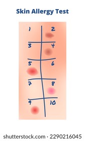 Vektorgrafik des Allergietests der Haut einzeln. Menschliche Haut mit einer mikroskopischen Menge an Allergenen und roten Flecken oder Hautausschlag - Reaktion auf eine Allergie. Hautpest, intradermischer Test, Kratztest oder Schrott.