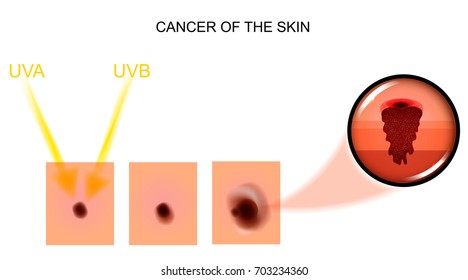 vector illustration of skin cancer. Oncology, surgery