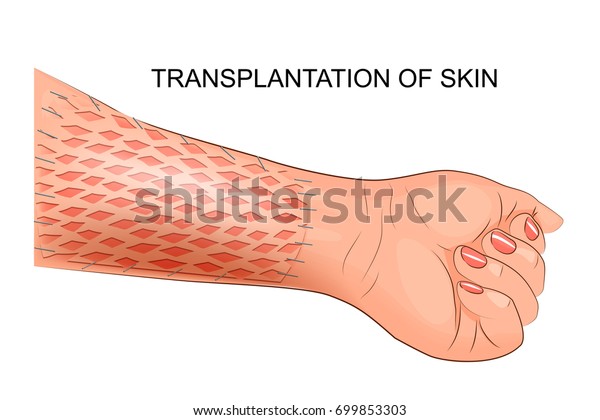 Vector Illustration Skin Graft Plastic Surgery 库存矢量图 免版税 699853303