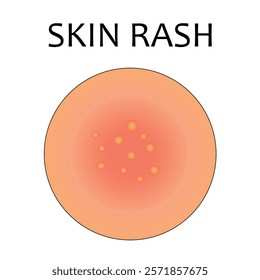 vector illustration of skin rash. Acne, allergy, dermatitis, eczema, skin irritation, itchy, dermatology. Isolated on white background