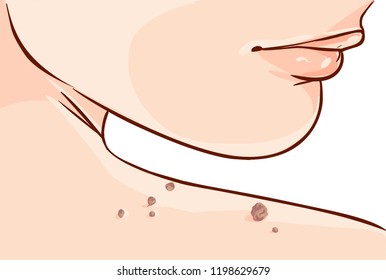 Vector illustration of a Skin Tag Removal Methods