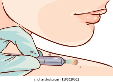 Vector Illustration Of A Skin Tag Removal Methods