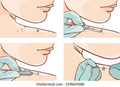 Vector illustration of a Skin Tag Removal Methods