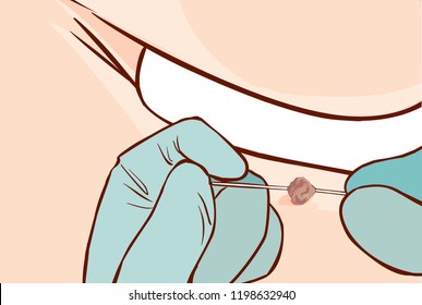Vector illustration of a Skin Tag Removal Methods