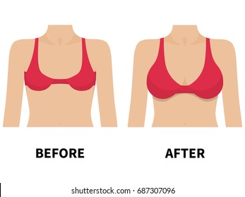 Vector illustration of a small chest and big in a red bra. Isolated white background. Female breast before and after plastic surgery. Flat style.