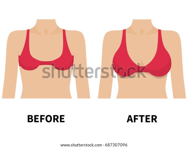 赤いブラジャーに小さな胸と大きな胸のベクターイラスト 白い背景 整形前後の女性の乳房 フラットスタイル のベクター画像素材 ロイヤリティフリー