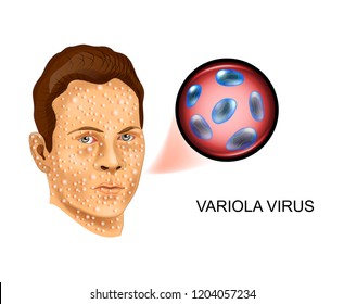 vector illustration of smallpox virus. the defeat of the face