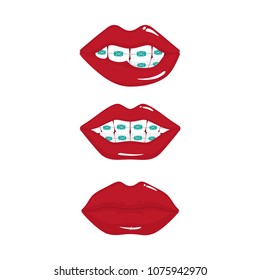  Vector illustration. Smiling teeth with braces and red lips. Ceramic braces. Colors braces. 