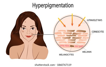 Vector illustration of smiling young pretty girl with skin pigmentation problem. Anatomical dermatological info graphic mechanism of dark spot melanin cells. Scheme UV solar rays impact on skin color