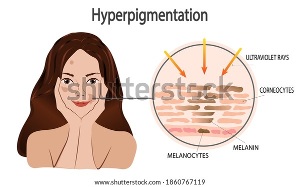 Vector illustration of smiling young pretty girl\
with skin pigmentation problem. Anatomical dermatological info\
graphic mechanism of dark spot melanin cells. Scheme UV solar rays\
impact on skin color