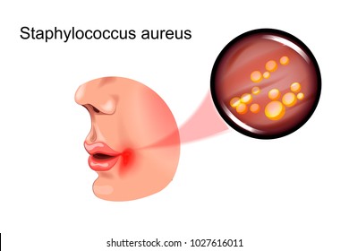 vector illustration of a sore on face. staphylococcus