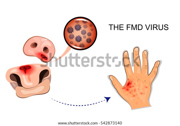 Vector Illustration Sores Route Transmission Medical Stock Vector ...