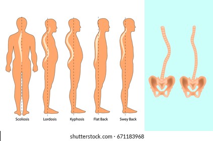 Ilustración vectorial de los tipos de deformidad espinal: escoliosis, lordosis y kyphosis.Defecto de postura corporal. Infografía de enfermedades de la columna vertebral.