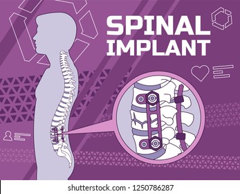 Vector Illustration Of The Spinal Implant Medical Concept