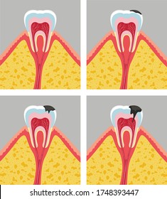 Vector illustration of spoiled teeth. Stages of tooth decay