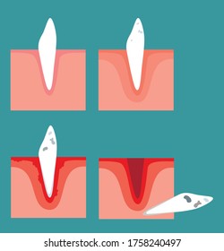 Vector illustration of spoiled teeth. Stages of tooth decay