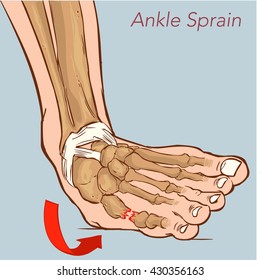  vector illustration of a Sprained ankle on blue