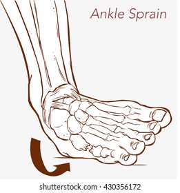  vector illustration of a Sprained ankle on white