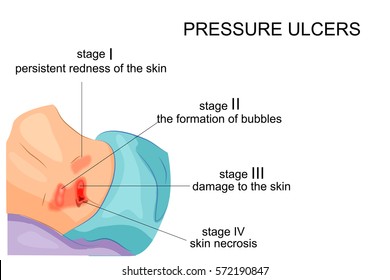 vector illustration of the stage of formation of bedsores