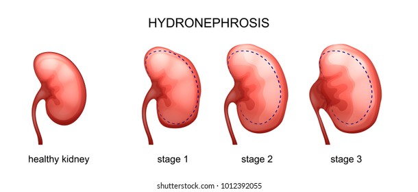 vector illustration of the stage of hydronephrosis