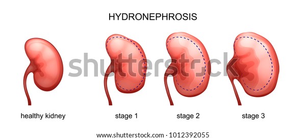 stages of kidney