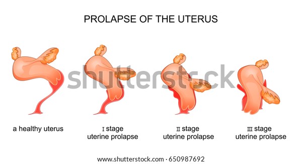 子宮脱期のベクターイラスト のベクター画像素材 ロイヤリティフリー