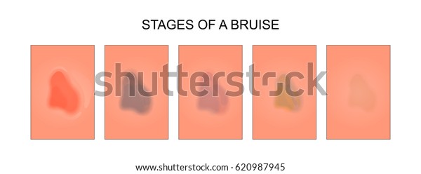 black and bruised stages