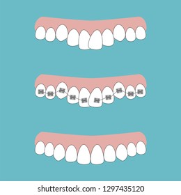 Vector illustration of the stages of orthodontic treatment braces on teeth . Teeth before and after braces on . Background in flat style