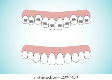 Vector illustration of the stages of orthodontic treatment braces on teeth . Teeth before and after braces on . Background in flat style