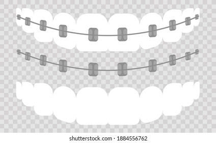 Ilustración vectorial de las etapas del tratamiento ortodoncista de los dientes. Los dientes antes y después se prenden.