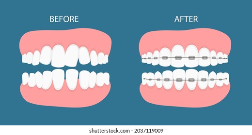 Vector illustration of stages of orthodontic treatment braces on teeth . Teeth before , after braces on . Background in flat style.vector on blue background. Dental concept.