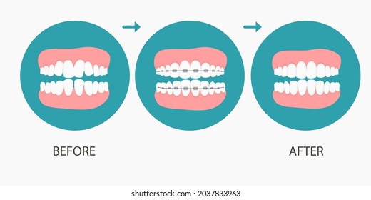 Vector illustration of stages of orthodontic treatment braces on teeth . Teeth before , after braces on . Background in flat style.vector on blue background. Dental concept.