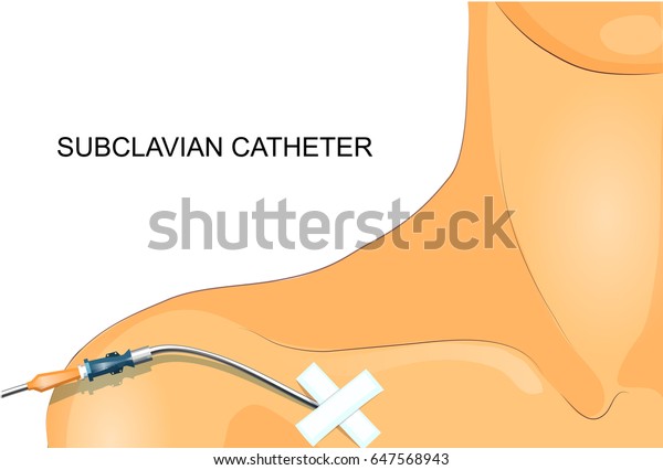 鎖骨下カテーテルの病期分類のベクターイラスト のベクター画像素材 ロイヤリティフリー 647568943