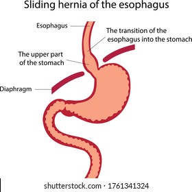 300 Normal esophagus Images, Stock Photos & Vectors | Shutterstock