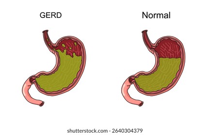 Vector illustration stomach disease, Gastroesophageal Reflux Disease. Comparison of normal stomach with GERD stomach. Illustration for medical, poster or science study