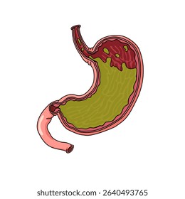 Vector illustration stomach disease Gastroesophageal Reflux Disease. GERD stomach. Illustration for medical, poster symbol, logo, or study science