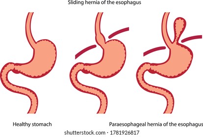 Vector Illustration Stomach Disease Paraesophageal Hernia Stock Vector ...